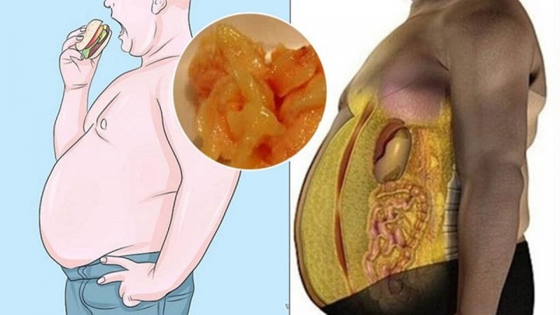 Abdominoplastia após Cesárea