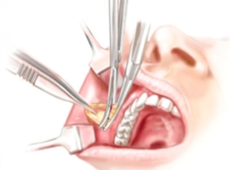 Bichectomia para Dentistas