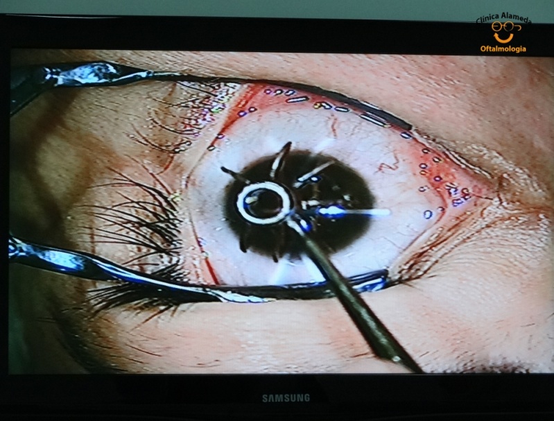 Cirurgia Ocular para Perto