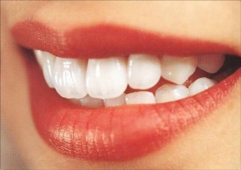 Clareamento Dental de Dentista
