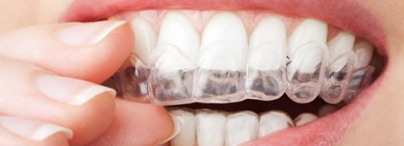 Clareamento Dental Interno