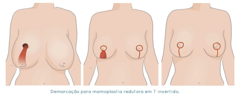 Clínica de Redução de Mama em São Paulo