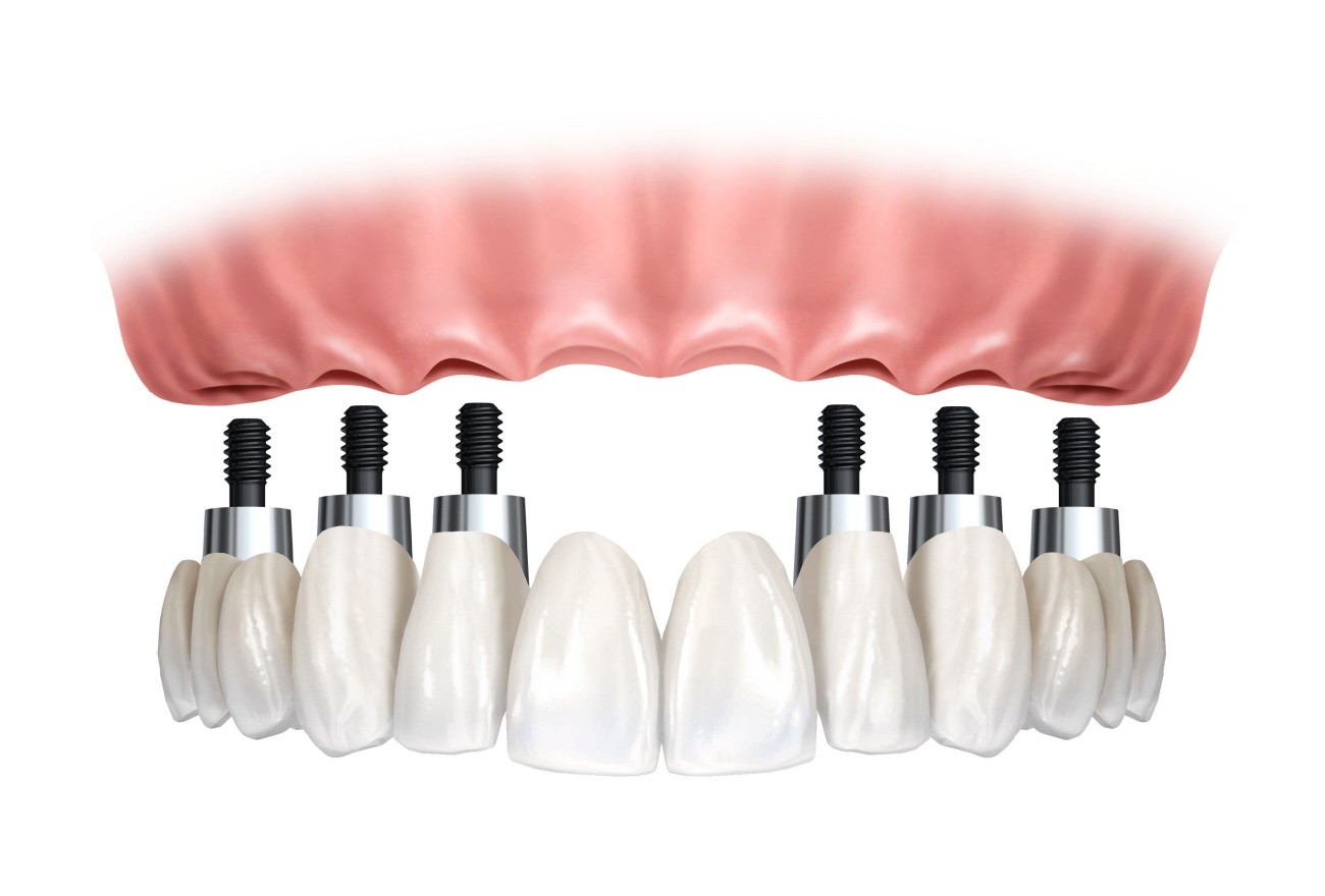 Consultório de Implante Dentário