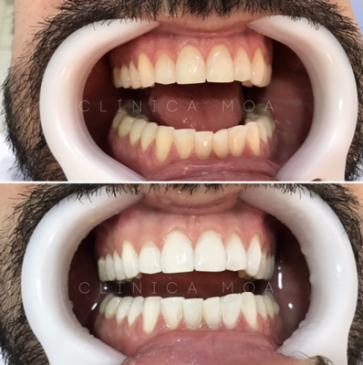 Estética Dental com Clareamento