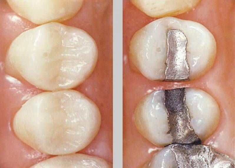 Estética Dentária com Resina