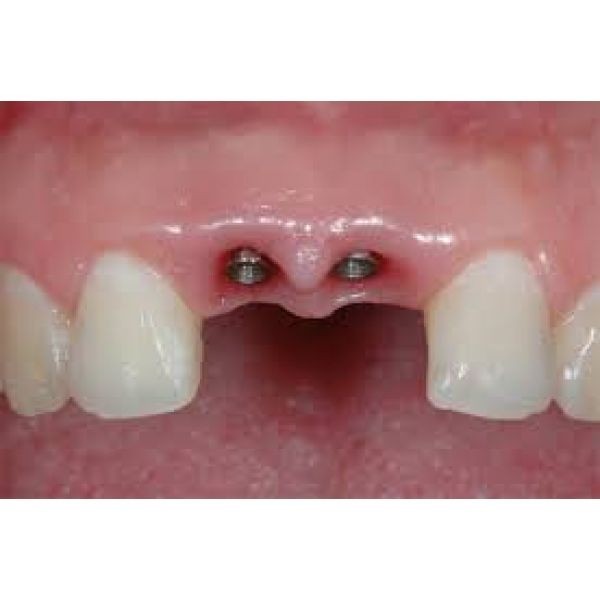 Implante de Dentes
