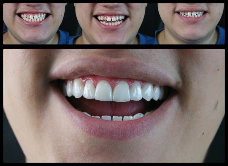 Implante de Odontologia
