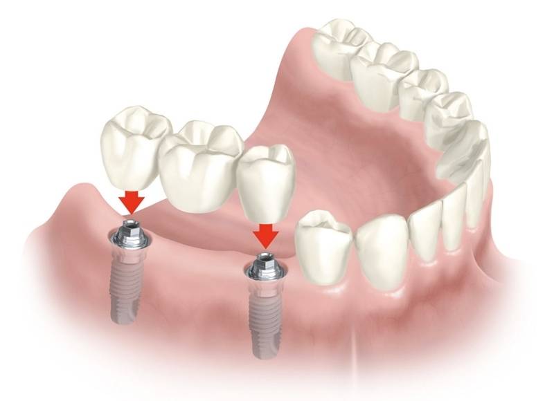 Implante Dentário Dente da Frente