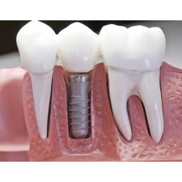 Implante Dentário em SP