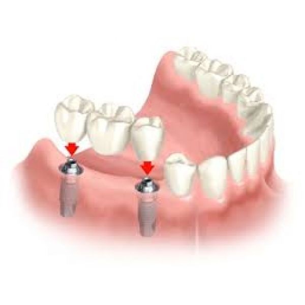 Implante Dentário no Itaim Bibi