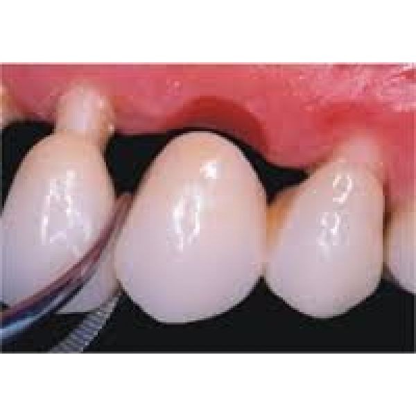 Implante Odontológico