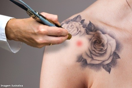 Laser para Remoção de Tatuagem