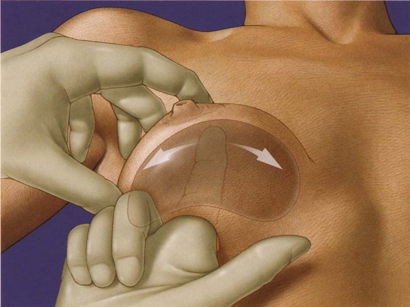 Mamoplastia para Flacidez