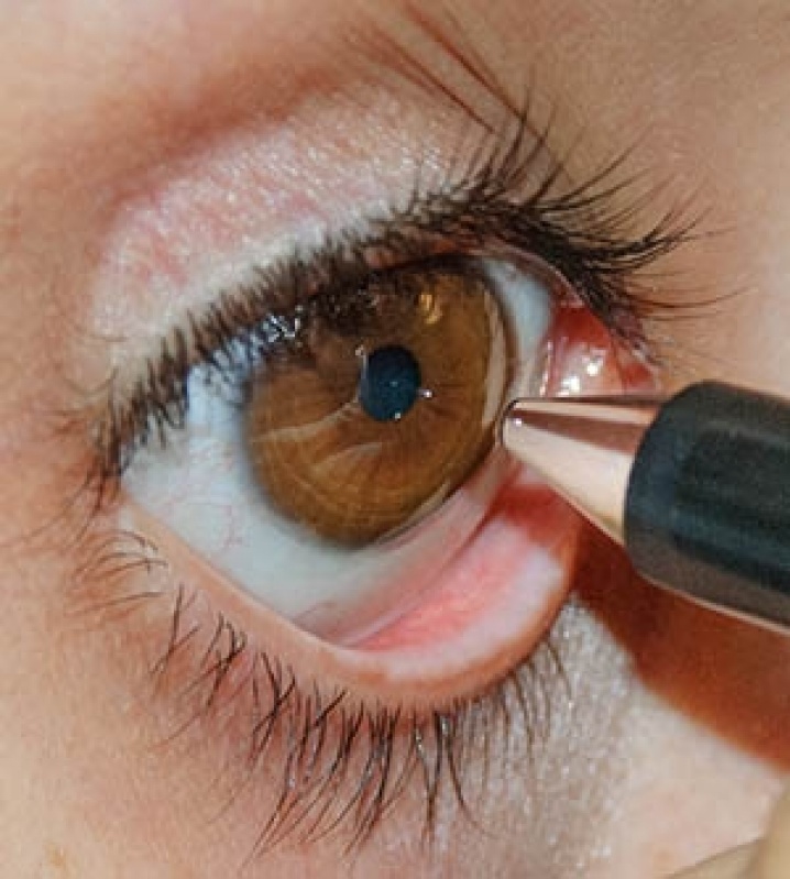 Paquimetria Ultrassônica Ocular