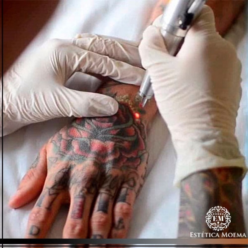 Remoção de Tatuagem ácido