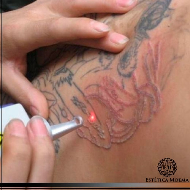 Remoção de Tatuagem com Laser