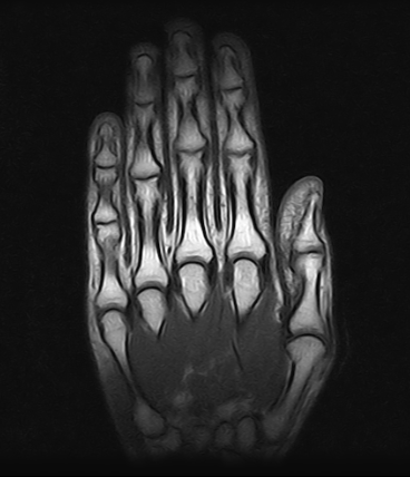 Ressonância Magnética da Mão no ABC