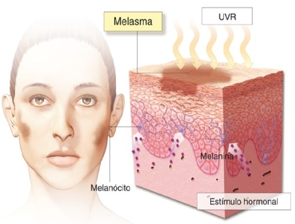 Tratamento a Laser para Melasma