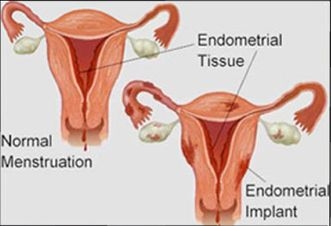 Tratamento de Endometriose para Engravidar