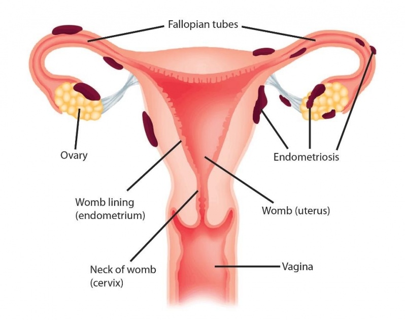 Tratamento de Endometriose