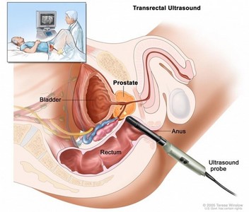 Ultrassonografia de Próstata