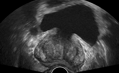 Ultrassonografia Detecta Câncer de Próstata