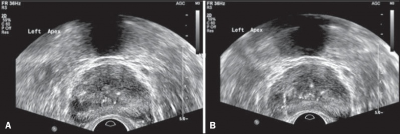Ultrassonografia Pélvica Próstata
