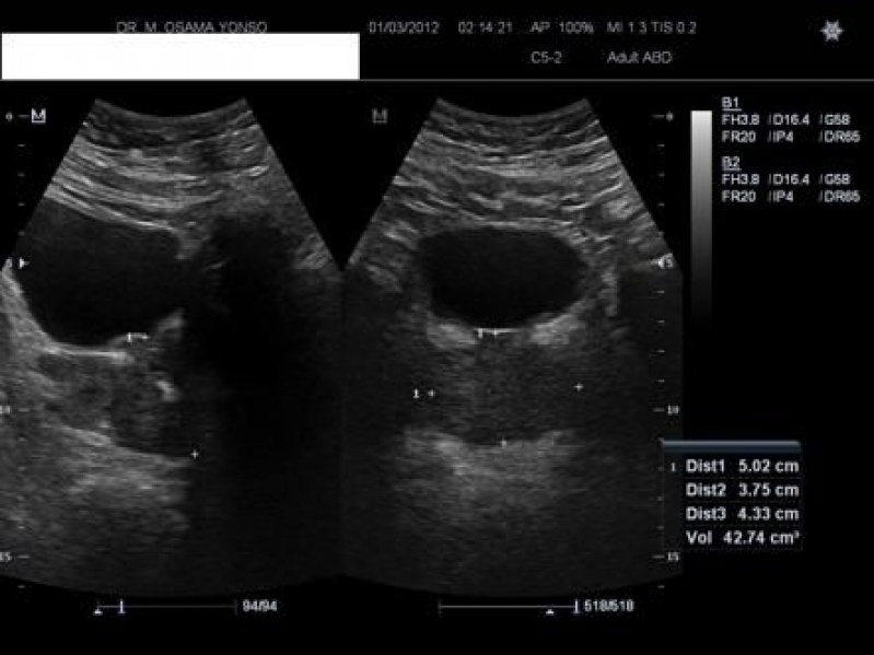 Ultrassonografia Próstata Aumentada