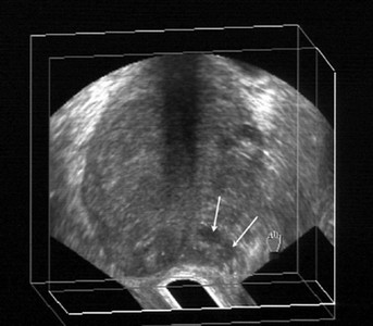 Ultrassonografia Transretal de Próstata com Biopsia